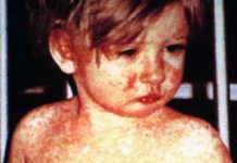 A child showing classic day-4 rash with measles. (Courtesy of Wikipedia)