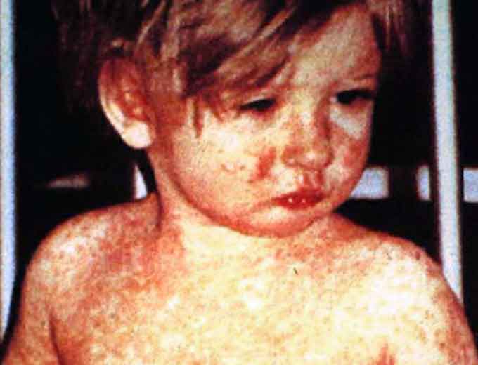 A child showing classic day-4 rash with measles. (Courtesy of Wikipedia)