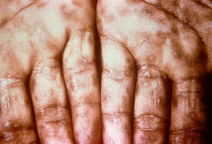 Typical presentation of secondary syphilis with a rash on the palms of the hands. (Courtesy of Wikipedia)