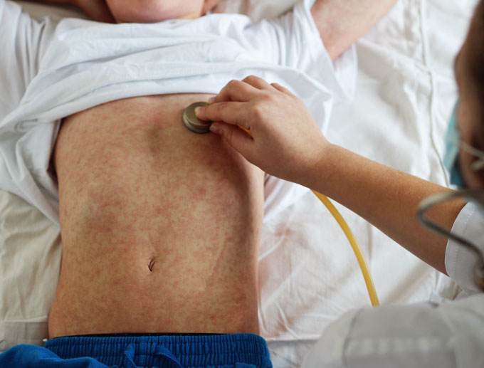 As of December 5th, 1,276 new cases of measles were reported in 31 states for 2019, making it the largest number of cases reported in the U.S. since 1992 (963 cases).