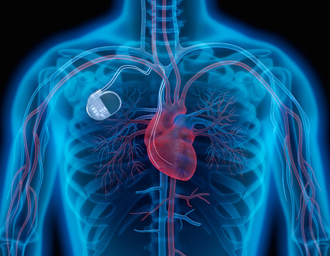 It is important that patients keep any consumer electronic devices such as cell phones, and smart watches, that may create magnetic interference, at least six inches away from implanted medical devices, in particular cardiac defibrillators, warns the FDA.