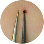 tick removal