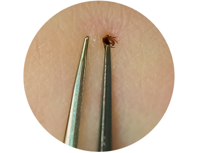 Use fine-tipped tweezers to grasp the tick as close to the skin’s surface as possible. Pull upward with steady, even pressure. Don’t twist or jerk the tick; this can cause the mouth-parts to break off and remain in the skin. If this happens, remove the mouth-parts with clean tweezers. If you are unable to remove the mouth parts easily, leave them alone and let the skin heal. (Courtesy of the CDC)